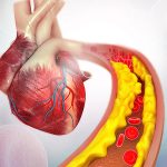 گرفتگی عروق به دلیل رسوب کلسترول در دیواره عروق