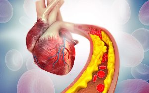 گرفتگی عروق به دلیل رسوب کلسترول در دیواره عروق